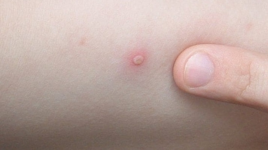 9. Symptoms: The symptoms of monkeypox and chickenpox are almost similar such as cold, fever, body ache, muscle ache, and fatigue where both lead to a widely disseminated rashes.(Pinterest)
