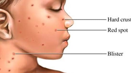 2. Rash: Monkeypox patient develops rash within 1 to 5 days and it begins on the face and then spreads to other parts of the body. In case of chickenpox, rash appears on the chest, back, and then on the face and entire body. It causes between 250 to 500 itchy blisters.(Pinterest)