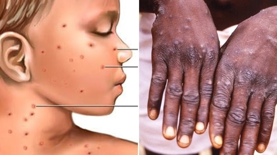 As monkeypox creates panic after being identified in several countries, it is important to know how the disease spreads. Some of its symptoms are similar to chickenpox like cold, fever, rash, body ache and fatigue. Dr. Subhash Kakkar, ENT Sr. Surgeon founder of Kakkar ENT Clinic (Karol Bagh), visiting consultant with BL Kapur hospital and Apollo Spectra lists the differences between monkeypox and chickenpox as per CDC (USA) guidelines.(Pinterest)