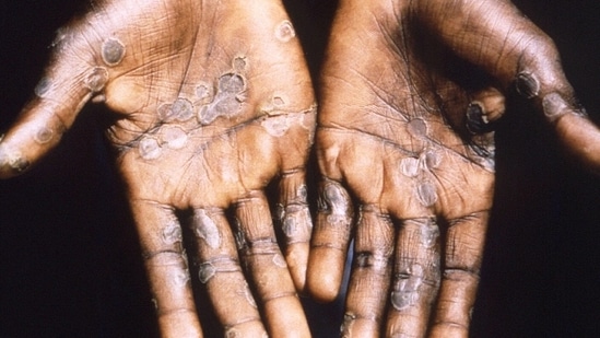 6. Transmission: Monkeypox virus enters the body via broken skin, respiratory tract, and mucus membrane while chickenpox virus enters mainly via respiratory tracts.(Reuters)