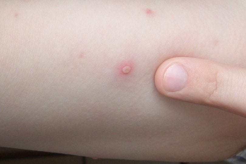 Monkeypox is caused by the monkeypox virus which belongs to the orthopoxvirus family, according to the World Health Organization. (Pinterest. Representative image)
