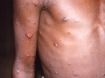 This 1997 image provided by U.S. Centers for Disease Control and Prevention shows the right arm and torso of a patient, whose skin displayed a number of lesions due to what had been an active case of monkeypox. (CDC via AP, File)(AP) This 1997 image provided by U.S. Centers for Disease Control and Prevention shows the right arm and torso of a patient, whose skin displayed a number of lesions due to what had been an active case of monkeypox. (CDC via AP, File)(AP)