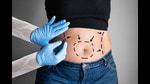 There are two types of liposuction procedures — of less than five litres and more than five litres — and the former is considered safer. (Photo: Shutterstock) There are two types of liposuction procedures — of less than five litres and more than five litres — and the former is considered safer. (Photo: Shutterstock)
