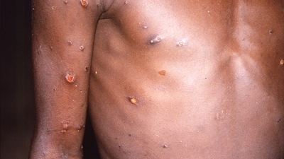 This 1997 image provided by U.S. Centers for Disease Control and Prevention shows the right arm and torso of a patient, whose skin displayed a number of lesions due to what had been an active case of monkeypox. (CDC via AP, File) (AP)