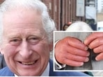 Recent pictures of Prince Charles' swollen fingers have once caught attention of internet community who showed their concern over the royal's condition