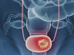 Bladder Cancer Awareness Month 2022: Is your coffee giving you cancer? Watch out for these warning signs, symptoms (Twitter/MedscapeCME) Bladder Cancer Awareness Month 2022: Is your coffee giving you cancer? Watch out for these warning signs, symptoms (Twitter/MedscapeCME)