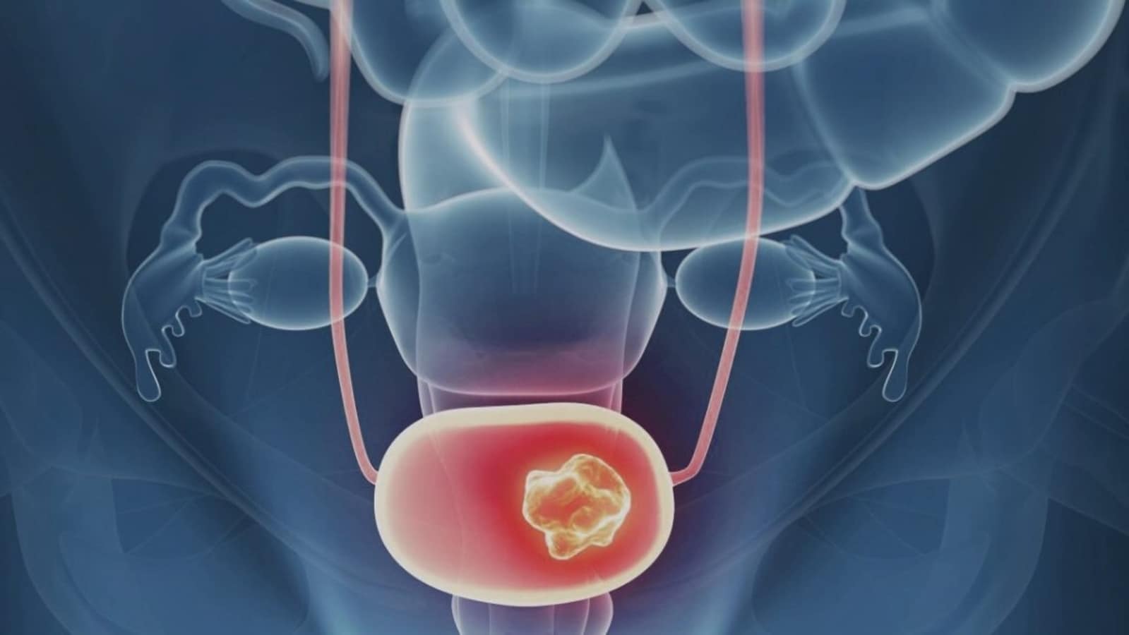 Bladder Cancer Awareness Month 2022: Watch out for these warning signs, symptoms | Health