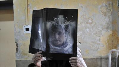 An elderly tuberculosis patient checks her X-ray at the Chest Disease Hospital in Srinagar, Kashmir. (Waseem Andrabi/Hindustan Times) An elderly tuberculosis patient checks her X-ray at the Chest Disease Hospital in Srinagar, Kashmir. (Waseem Andrabi/Hindustan Times)