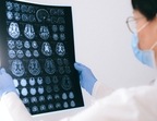 World Brain Tumour Day 2022: Early signs of brain tumour among youngsters (Anna Shvets) World Brain Tumour Day 2022: Early signs of brain tumour among youngsters (Anna Shvets)