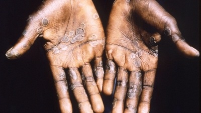Monkeypox virus enters the body via broken skin, respiratory tract, and mucus membrane while chickenpox virus enters mainly via respiratory tracts. (Reuters) Monkeypox virus enters the body via broken skin, respiratory tract, and mucus membrane while chickenpox virus enters mainly via respiratory tracts. (Reuters)