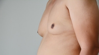 Gynaecomastia: Causes, symptoms and treatment (Unsplash) Gynaecomastia: Causes, symptoms and treatment (Unsplash)