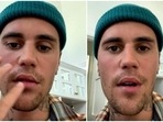 Justin Bieber recently said he has Ramsay Hunt syndrome.(Justin Bieber/Instagram) Justin Bieber recently said he has Ramsay Hunt syndrome.(Justin Bieber/Instagram)