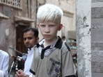 International Albinism Awareness Day 2022: Know all about its date, history, significance, theme (Image by Babar Ali from Pixabay ) International Albinism Awareness Day 2022: Know all about its date, history, significance, theme (Image by Babar Ali from Pixabay )