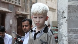 International Albinism Awareness Day 2022: Know all about its date, history, significance, theme&nbsp;
