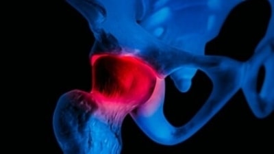 Avascular Necrosis: Causes, symptoms and treatment (Unsplash) Avascular Necrosis: Causes, symptoms and treatment (Unsplash)