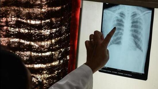 Digital radiography is an advanced form of X-ray inspection that produces a digital image instantly on a computer. (AFP/for representation only)
