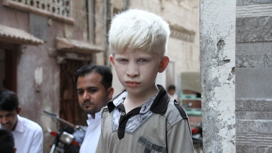 International Albinism Awareness Day 2022: Know all about its date, history, significance, theme (Image by Babar Ali from Pixabay ) International Albinism Awareness Day 2022: Know all about its date, history, significance, theme (Image by Babar Ali from Pixabay )
