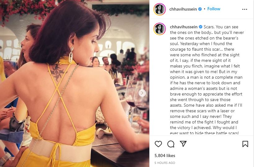 Chhavi Mittal posted a photo of her breast cancer surgery scar.