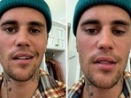 Justin Bieber revealed his Ramsay Hunt syndrome diagnosis on June 10 via Instagram. Justin Bieber revealed his Ramsay Hunt syndrome diagnosis on June 10 via Instagram.