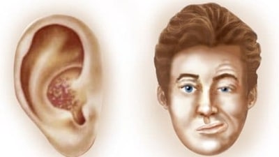 Ramsay Hunt syndrome (RHS) is a rare neurological disorder accompanied by paralysis of the facial nerve (facial palsy) and a rash affecting the ear or mouth but there is not much awareness regarding it. The varicella-zoster virus is the factor causing Ramsay Hunt syndrome and it is the same virus that leads to chickenpox and shingles. If one has this syndrome then the virus will infect the facial nerve near the inner ear which causes irritation and swelling of the nerve. It is seen in adults and occurs rarely in children. In an interview with HT Lifestyle, Dr Pavan Pai, Interventional Neurologist at Wockhardt Hospitals, Mira Road, revealed, “The symptoms of it are ear pain, rash on the eardrum, ear canal, earlobe, tongue, and roof of the mouth on the side with the affected nerve, hearing loss on one side, vertigo, facial paralysis, and problems in opening the eyes.” (Twitter/DrAo94) Ramsay Hunt syndrome (RHS) is a rare neurological disorder accompanied by paralysis of the facial nerve (facial palsy) and a rash affecting the ear or mouth but there is not much awareness regarding it. The varicella-zoster virus is the factor causing Ramsay Hunt syndrome and it is the same virus that leads to chickenpox and shingles. If one has this syndrome then the virus will infect the facial nerve near the inner ear which causes irritation and swelling of the nerve. It is seen in adults and occurs rarely in children. In an interview with HT Lifestyle, Dr Pavan Pai, Interventional Neurologist at Wockhardt Hospitals, Mira Road, revealed, “The symptoms of it are ear pain, rash on the eardrum, ear canal, earlobe, tongue, and roof of the mouth on the side with the affected nerve, hearing loss on one side, vertigo, facial paralysis, and problems in opening the eyes.” (Twitter/DrAo94)