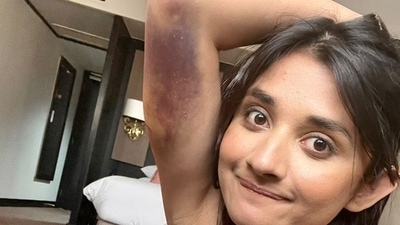 Kanika Mann's picture with bruises on her arms. Kanika Mann's picture with bruises on her arms.