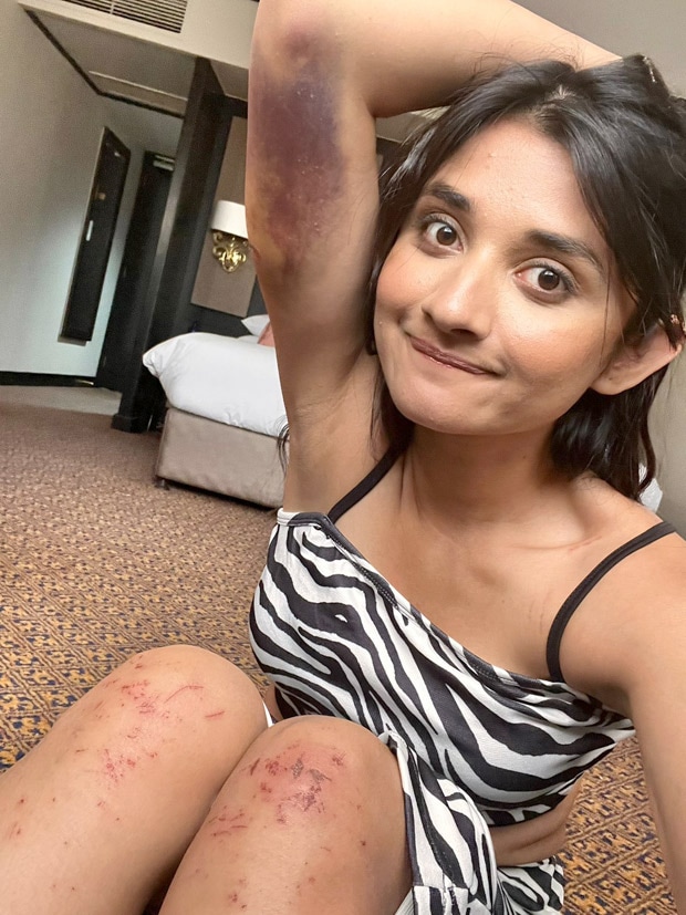 620px x 827px - Khatron Ke Khiladi 12: Kanika Mann injured doing stunts, shows bruises in  pic - Hindustan Times