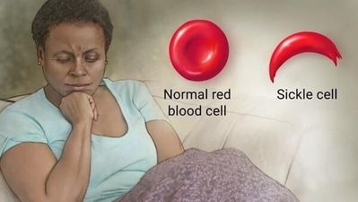 Sickle cell disease: Doctors reveal its causes, symptoms, preventive measures, treatment and therapies (Twitter/EllenDomaeko) Sickle cell disease: Doctors reveal its causes, symptoms, preventive measures, treatment and therapies (Twitter/EllenDomaeko)