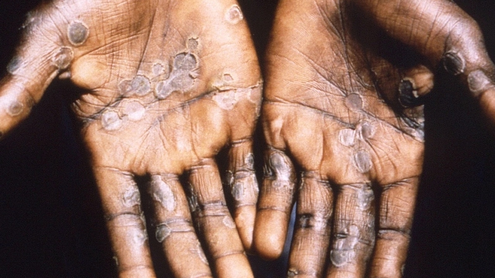 What you need to know about monkeypox - Mayo Clinic Health System