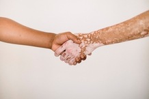 Vitiligo: Oral, laser, tratamento cirúrgico para leucoderma ou hanseníase branca 