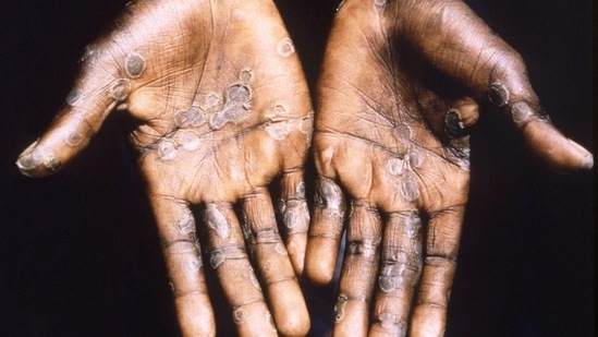 Monkeypox virus enters the body via broken skin, respiratory tract, and mucus membrane while chickenpox virus enters mainly via respiratory tracts.(Reuters) Monkeypox virus enters the body via broken skin, respiratory tract, and mucus membrane while chickenpox virus enters mainly via respiratory tracts.(Reuters)