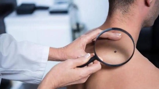 Researchers find molecular factors to treat melanoma skin cancer(Shutterstock)