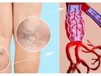 National Doctors' Day 2022: All you need to know about the causes, symptoms, preventive tips for Economy Class Syndrome or travellers thrombosis (Twitter/cuticahealth) National Doctors' Day 2022: All you need to know about the causes, symptoms, preventive tips for Economy Class Syndrome or travellers thrombosis (Twitter/cuticahealth)