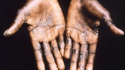 US health officials announce new monkeypox vaccination plan