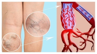 National Doctors' Day 2022: All you need to know about the causes, symptoms, preventive tips for Economy Class Syndrome or travellers thrombosis (Twitter/cuticahealth) National Doctors' Day 2022: All you need to know about the causes, symptoms, preventive tips for Economy Class Syndrome or travellers thrombosis (Twitter/cuticahealth)