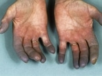 Buerger's Disease: Causes, symptoms, treatment of rare disease of the arteries and veins that affects your arms and legs (Twitter/gergerlioglueng) Buerger's Disease: Causes, symptoms, treatment of rare disease of the arteries and veins that affects your arms and legs (Twitter/gergerlioglueng)