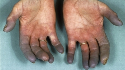 Buerger's Disease: Causes, symptoms, treatment of rare disease of the  arteries and veins that affects your arms and legs