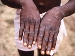 This 1997 image provided by the CDC during an investigation into an outbreak of monkeypox.