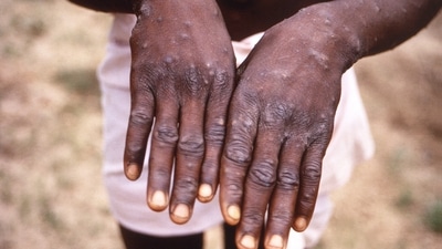 This 1997 image provided by the CDC during an investigation into an outbreak of monkeypox. (AP File Image) This 1997 image provided by the CDC during an investigation into an outbreak of monkeypox. (AP File Image)