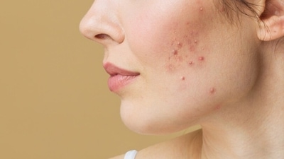 How to deal with hormonal acnes: Experts share tips (Unsplash) How to deal with hormonal acnes: Experts share tips (Unsplash)