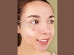 Beauty and skincare tips: Here's how to keep acne at bay during monsoons (Anna Nekrashevich) Beauty and skincare tips: Here's how to keep acne at bay during monsoons (Anna Nekrashevich)