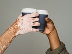 Vitiligo: Doctors debunk some common myths on leukoderma or white leprosy (Armin Rimoldi)