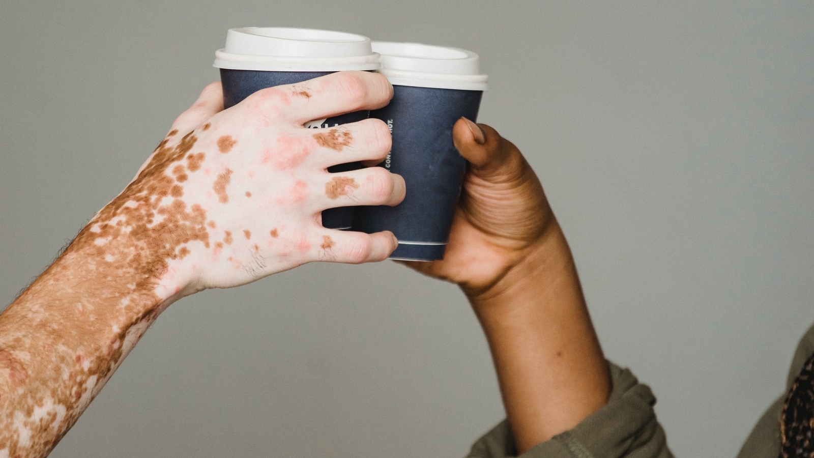 Vitiligo Doctors debunk some common myths on leukoderma or white