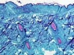 The genetics of the virus that causes monkeypox are relatively unknown. This is the kind of skin rash that the virus causes, viewed under a microscope.(CDC/REUTERS ) The genetics of the virus that causes monkeypox are relatively unknown. This is the kind of skin rash that the virus causes, viewed under a microscope.(CDC/REUTERS )