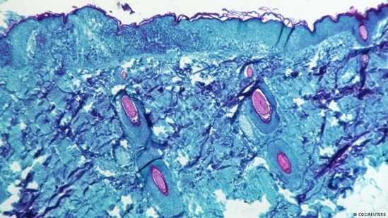 The genetics of the virus that causes monkeypox are relatively unknown. This is the kind of skin rash that the virus causes, viewed under a microscope.(CDC/REUTERS )