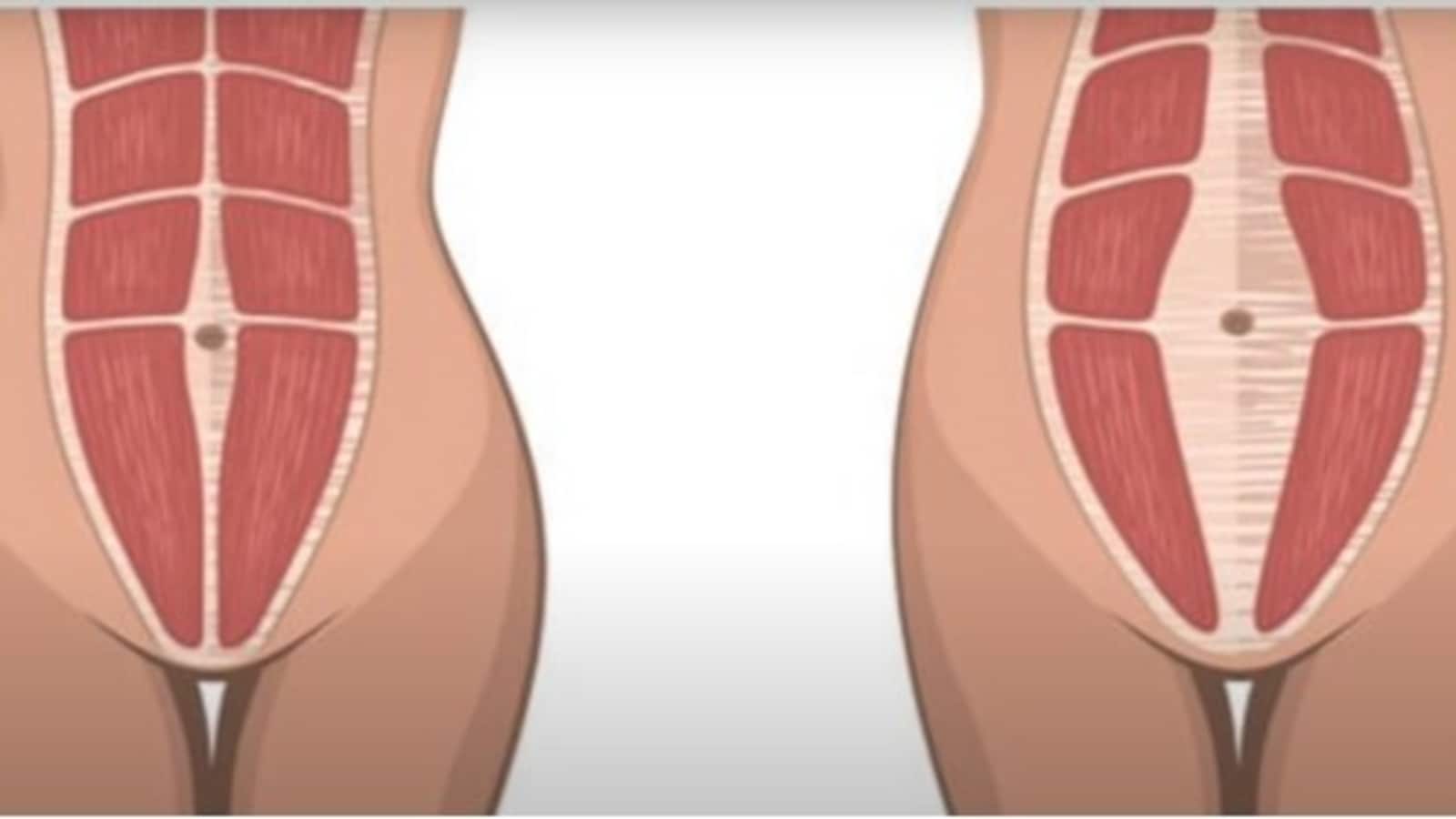 Diastasis Recti: Is It Normal To Have Postpartum Belly Pouch? - Motherhood  Hospitals India