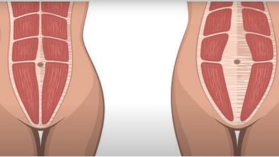 Get Rid Of Mommy Tummy with 3 Simple Diastasis Recti Exercises