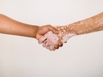 New way to reduce inflammation and prevent repigmentation in vitiligo patients(Armin Rimoldi) New way to reduce inflammation and prevent repigmentation in vitiligo patients(Armin Rimoldi)