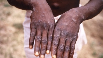 This handout photo provided by the Centers for Disease Control and Prevention was taken in 1997 during an investigation into an outbreak of monkeypox, which took place in the Democratic Republic of the Congo (DRC), and depicts the dorsal surfaces of a monkeypox case in a patient who was displaying the appearance of the characteristic rash during its recuperative stage. (AFP) This handout photo provided by the Centers for Disease Control and Prevention was taken in 1997 during an investigation into an outbreak of monkeypox, which took place in the Democratic Republic of the Congo (DRC), and depicts the dorsal surfaces of a monkeypox case in a patient who was displaying the appearance of the characteristic rash during its recuperative stage. (AFP)