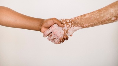 New way to reduce inflammation and prevent repigmentation in vitiligo patients (Armin Rimoldi)