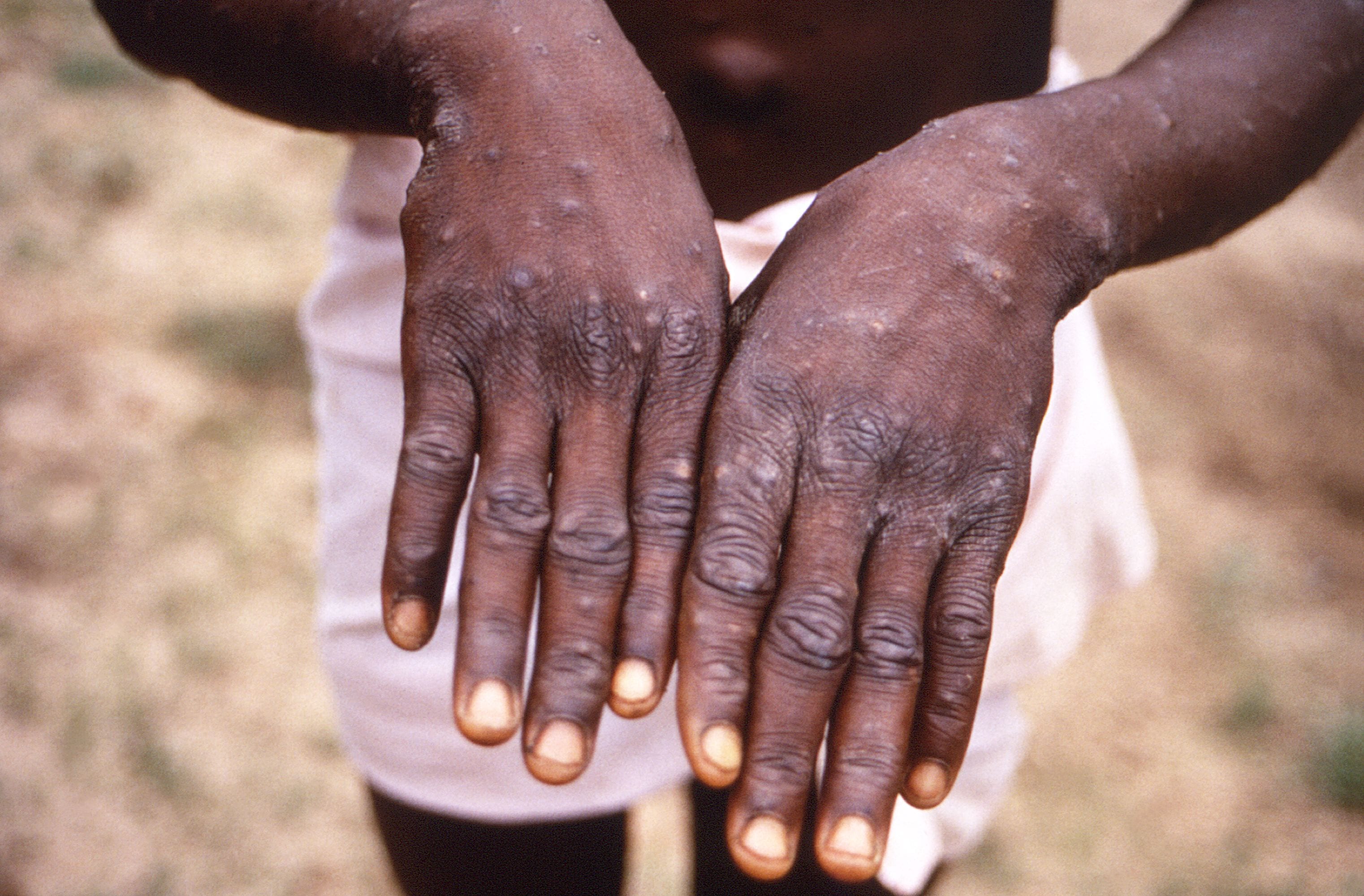 A viral infection, monkeypox can spread by contact with an infected person or infected animal, contact with their body fluids or any material contaminated with the virus or during intimate physical contact(AFP) A viral infection, monkeypox can spread by contact with an infected person or infected animal, contact with their body fluids or any material contaminated with the virus or during intimate physical contact(AFP)